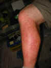 Nasty rashes on the Spooky St. Ives reporter's legs 2