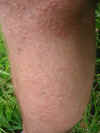 Nasty rashes on the Spooky St. Ives reporter's legs 1